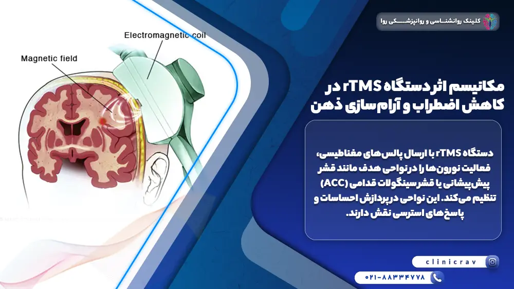 تصویر نغز و دستگاه rtms  و توضیح مکانیسم اثر دستگاه rTMS در کاهش اضطراب و آرام‌سازی ذهن
