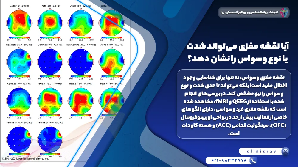نقشه مغزی افراد وسواسی با شدت های متفاوت وسواس